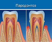 Пародонтоз