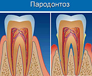 пародонтоз